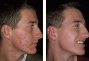 Como Quitar El Acne Rapido En 10 Pasos Como Quitar El Acne Rapido En 10 Pasos