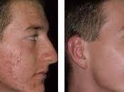 Formas Eliminar Acne Remedios Efectivos
