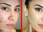 Como Puede Prevenir Acne Remedios Eficaces