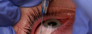 Tratamiento para la degeneración macular húmeda: ¿la fotocoagulación con láser es el tratamiento de su elección? ¿Qué tan efectivos son los tratamientos de degeneración macular relacionados con la edad?