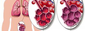 Enfisema: causas, síntomas y tratamiento