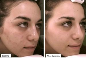 Como Hacer Desaparecer El Acne Rapidamente?