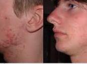 Metodos Caseros Para Quitar Acne Medicina Moderna