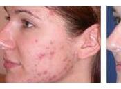 Como Acabar Acne Rapidamente Casa Definitivo
