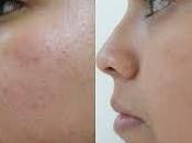 Como Quitar Rapido Acne Maneras Sencillas Debes Probar