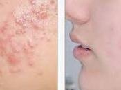 Como Quitar Acne Descubre Respuesta Ahora