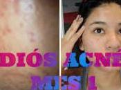 Quita Acne Rapido Tratamientos Médicos Naturales