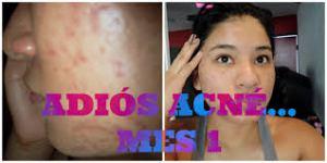 Con Que Se Quita El Acne Rapido – Los Tratamientos Médicos y Naturales