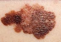 Nuevo objetivo Terapéutico para Tratar el Melanoma