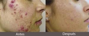 ¿Como Combatir El Acne Con Remedios Caseros?