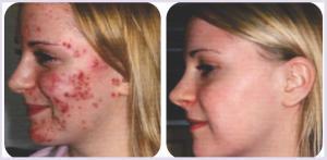 Tratamiento Natural Para El Acne Hormonal – Seguro y Eficaz