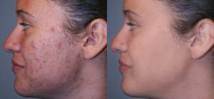 Que Debo Hacer Para Eliminar El Acne?