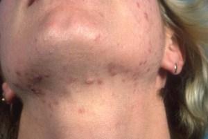 Como Hago Para No Tener Acne – Una Guía Rápida Como Hago Para No Tener Acne – Una Guía Rápida