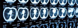 Estudio dice que es seguro evitar el tratamiento del cáncer de próstata Los cánceres cerebrales son a veces supervivientes: esto es lo que ayuda