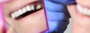Puentes, coronas e implantes: reemplazo permanente del diente en pacientes con cáncer