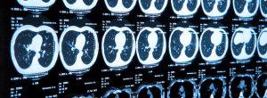 Los cánceres cerebrales son a veces supervivientes: esto es lo que ayuda