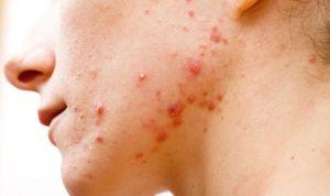 Como Sacar Acne Rapido Sin Cremas ni Medicina