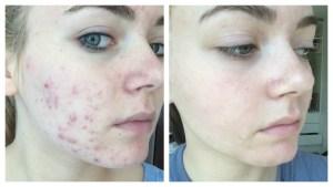 Como eliminar el acne naturalmente