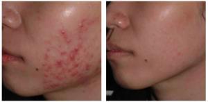 Tecnicas Simples Para Eliminar El Acne Rapidamente