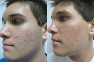 Como Eliminar Acne Naturalmente: 2 Errores Que Hay Que Evitar Como Eliminar Acne Naturalmente: 2 Errores Que Hay Que Evitar