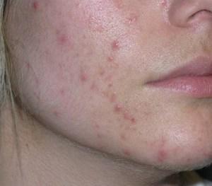 Como Sacar El Acne Rapidamente Con Un Plan Sencillo y Efectivo