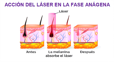 DEPILACIÓN LÁSER