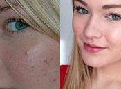 Hacer Contra Acne Agua Como Arma Acné