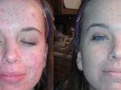 Como Combatir Acne Rapidamente Pierda Este Secreto