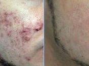 Como Puedo Quitar Acne?