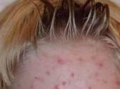 Como Desaparecer Acne Rapido Consejos Naturales Para