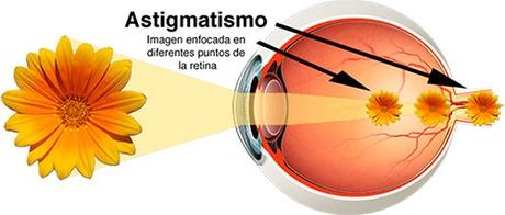 Ojo con astigmatismo
