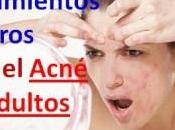 Medicamentos Naturales Para Acne