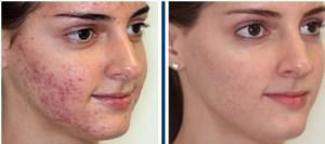 como eliminar acne del rostro Como Eliminar Acne Del Rostro?