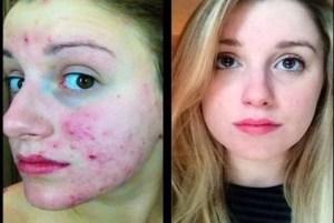 Como Eliminar Acne Del Rostro?