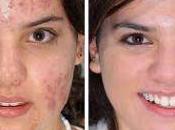 Puedo Hacer Para Eliminar Acne?