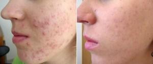 como eliminar el acne de mi cara Como Eliminar El Acne De Mi Cara?