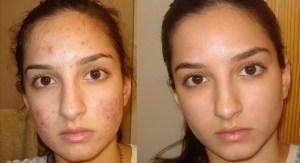 Como Me Puedo Quitar El Acne?