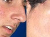 Como Puedo Quitar Acne?