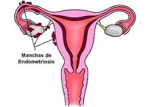 Qué es la endometriosis