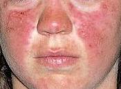 Belimumab Nuevo Farmaco para Tratar Lupus