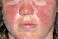 El Belimumab Nuevo Farmaco para Tratar el Lupus El Belimumab Nuevo Farmaco para Tratar el Lupus