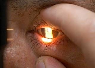 Crónico e irreversible, el glaucoma es segunda causa de ceguera en el mundo