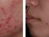 Como Reducir Acne Todas