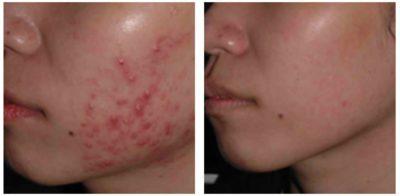 como reducir el acne Como Reducir El Acne De Una Vez Por Todas