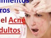 Tratamiento Naturista Para Acne Terapia Alternativa