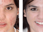 Eficaces Remedios Para Acne Severo Naturales