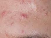 Como Quitar Barros Dela Frente?