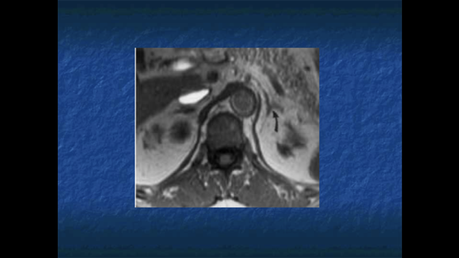 ANATOMIA RADIOLOGICA DE LAS GLANDULAS SUPRARRENALES.