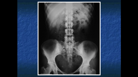 ANATOMIA RADIOLOGICA DE LAS GLANDULAS SUPRARRENALES.