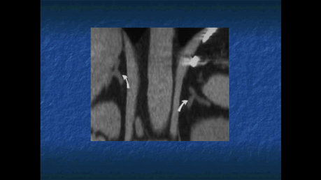 ANATOMIA RADIOLOGICA DE LAS GLANDULAS SUPRARRENALES.